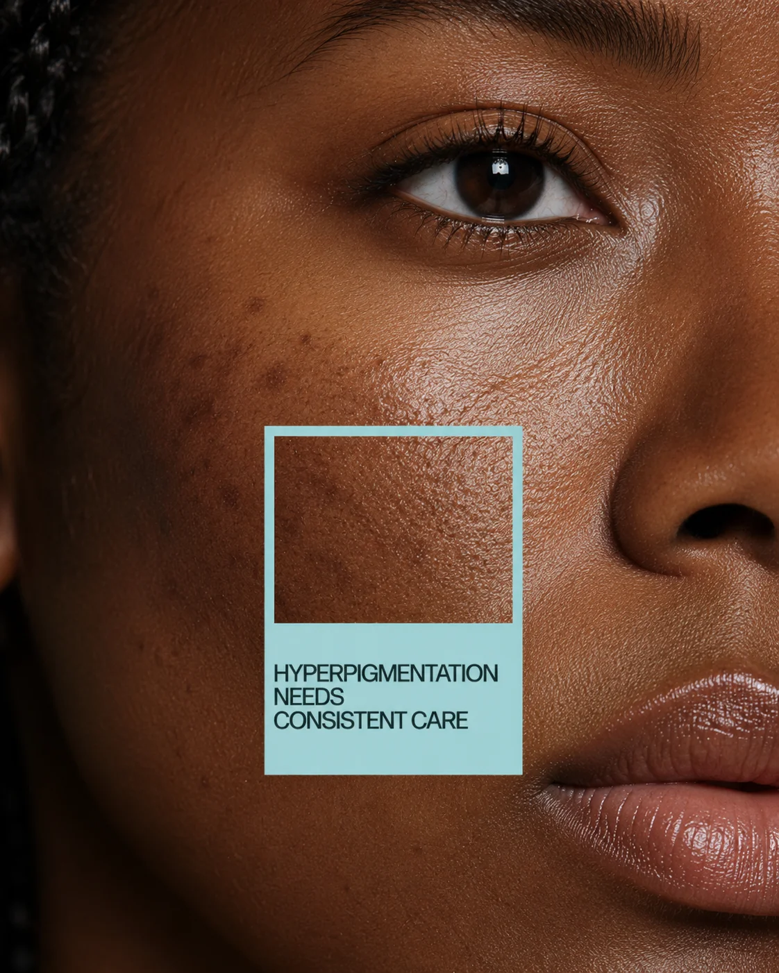 L'hyperpigmentation demande des soins constants